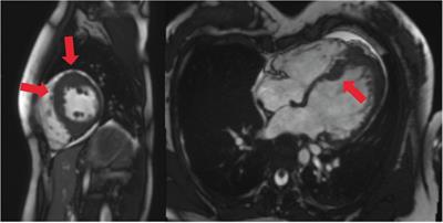 Case Report: Hypertrophic cardiomyopathy with recurrent episodes of ventricular fibrillation and concurrent sinus arrest